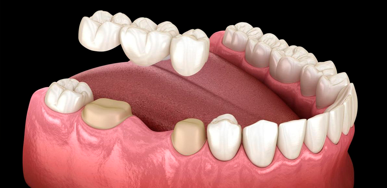 Dental Crowns in Los Algodones, Mexico: Restore Strength, Function, and Confidence
