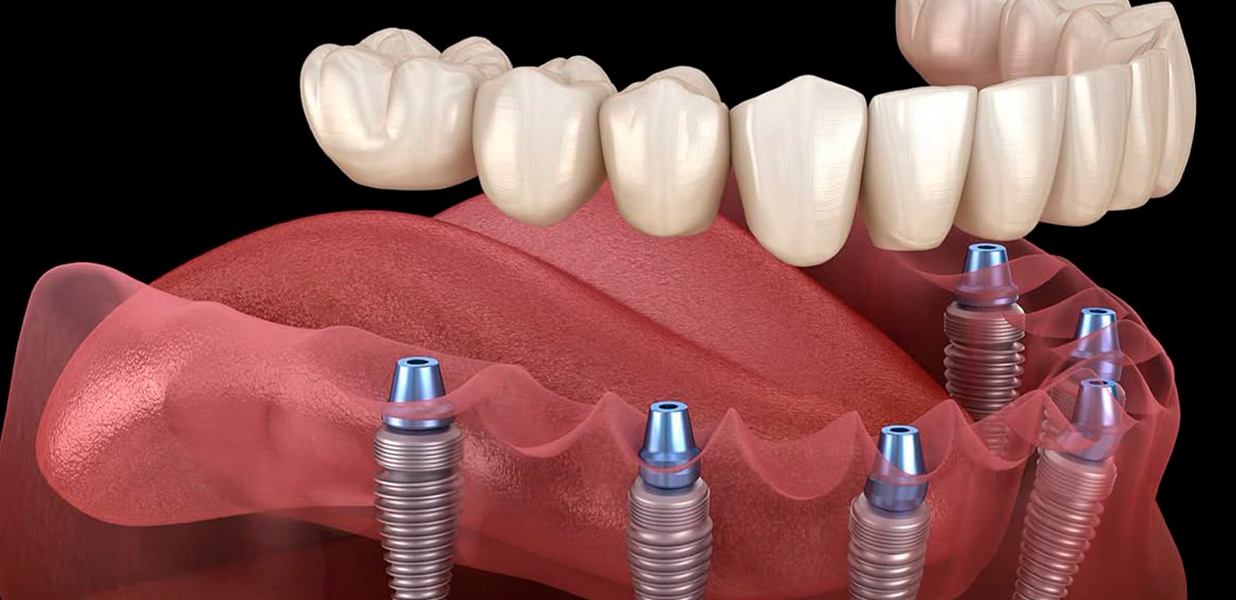 Dental Implants in Los Algodones, Mexico: A Long-Term Solution for Missing Teeth